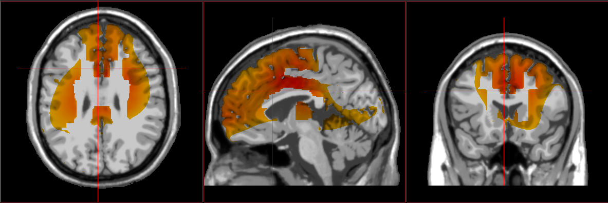 Autism / spectrum results from loreta neurofeedback