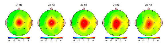 EEG brain scans showing patient with anxiety