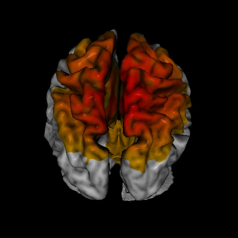 brain showing signs of anxiety with loreta neurofeedback