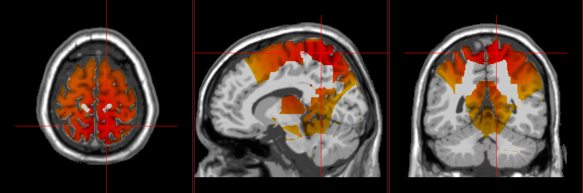 loreta neurofeedback graphic showing anxiety in the brain