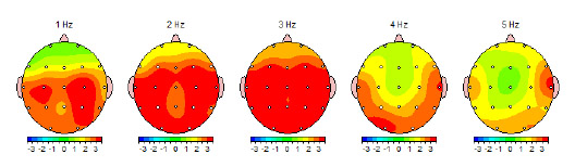 EEG brain scans showing typical results from autism