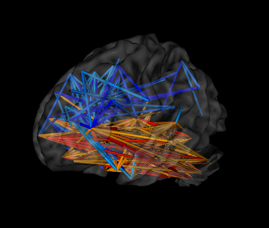 loreta neurofeedback showing signs of autism