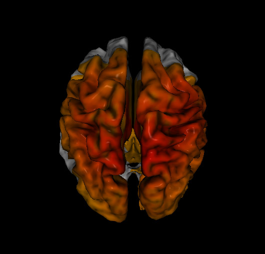 loreta neurofeedback showing typical indications of chronic pain