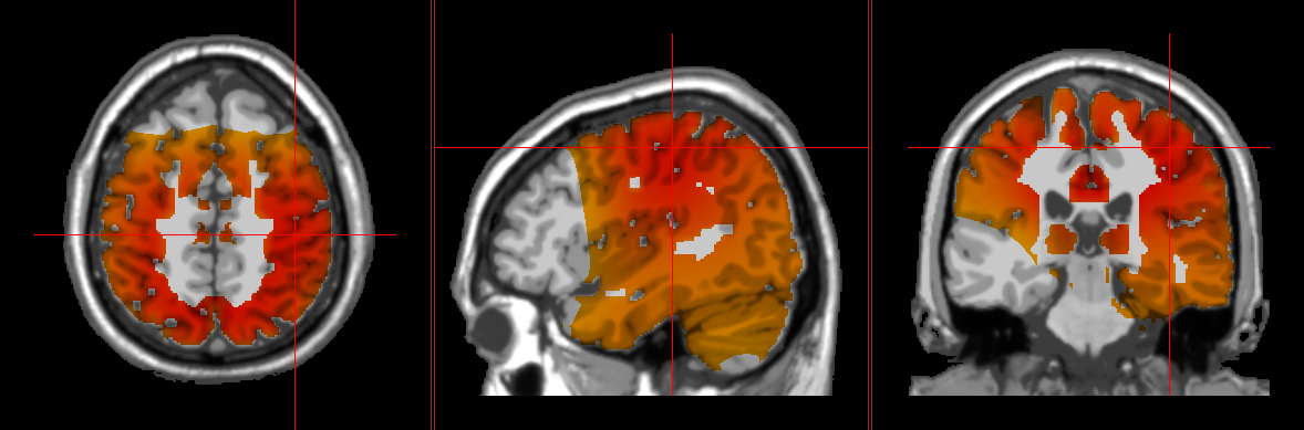 areas of the brain affected by chronic pain shown by the loreta neurofeedback