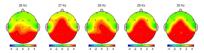 EEG brain scans showing patterns of PTSD
