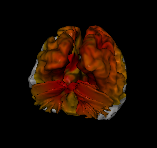 Loreta neurofeedback showing brain with PTSD