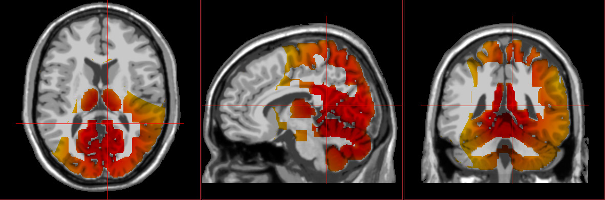 brain scan with lreta neurofeedback showing PTSD