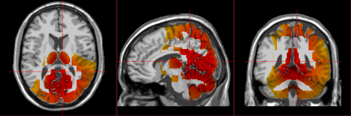 PTSD showing up in brain graphics from loreta neurofeedback results