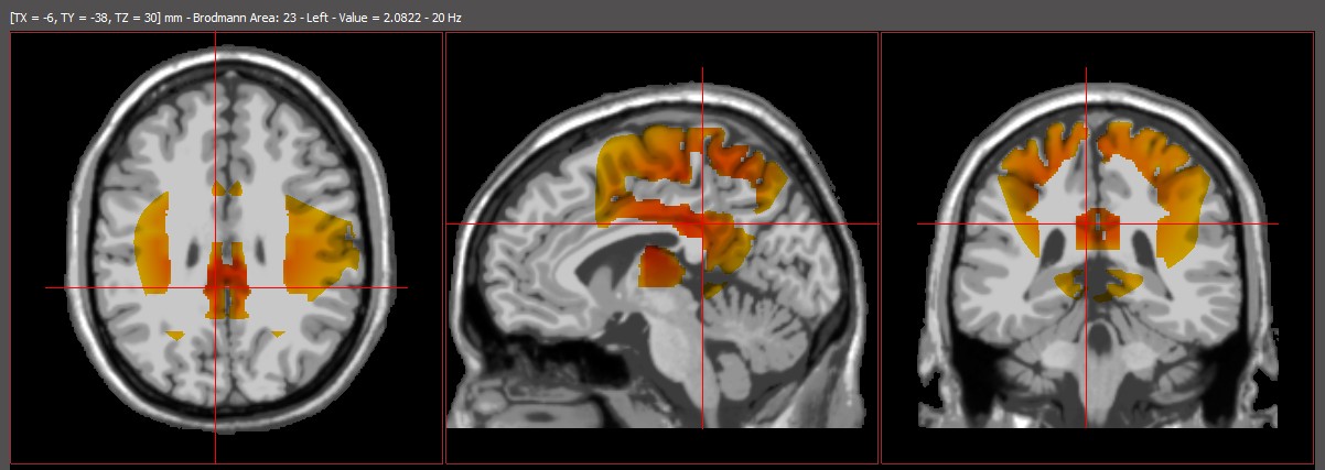 Neurogrove uses sw loreta neurofeedback for assessment