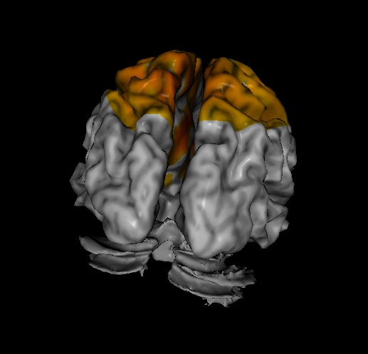 sample image from loreta neurofeedback assessment