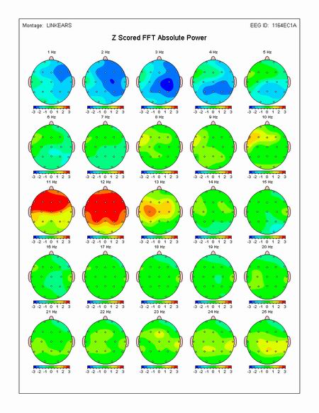 QEEG graphic of a brain